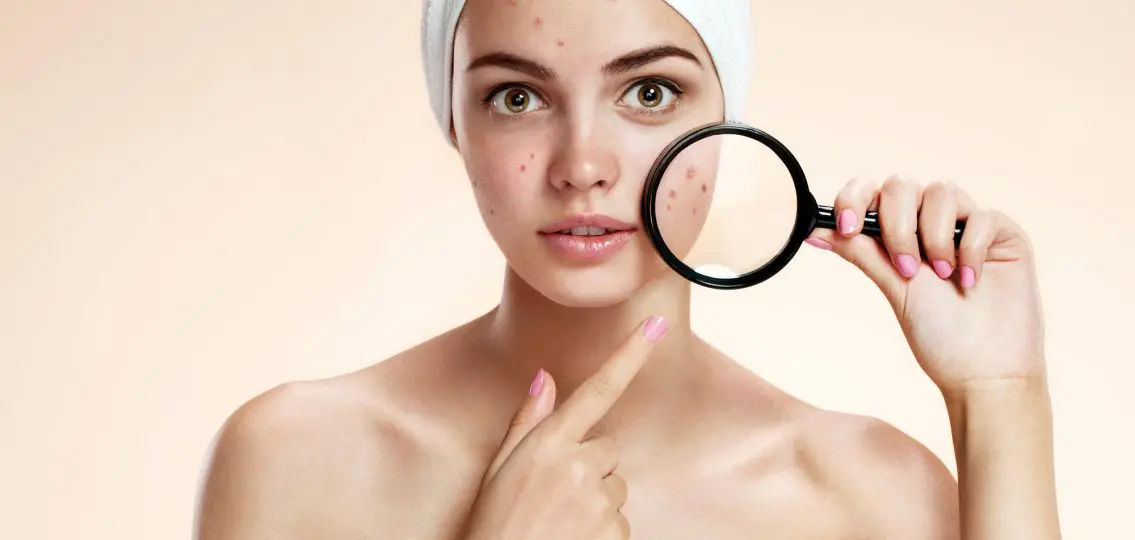 girl with magnifying glass magnifying her pimples